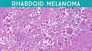 Rhabdoid Melanoma Metastatic to Lymph Node pathology dermatopathology dermatology dermpath [upl. by Nahpos608]