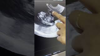 Healthy baby on scan  pregnancy scans  baby movements  dr Silpahasa shortsfeed gynaecologist [upl. by Nerte]