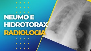 NEUMOTORAX E HIDRONEUMOTORAX EN RADIOGRAFÍA [upl. by Aysa]