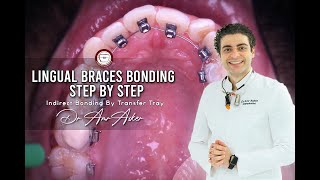 Lingual braces bonding step by step indirect bonding by transfer tray by Dr Amr Asker invisible [upl. by Eniar256]