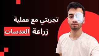 تجربتي مع عملية زراعة عدسات العين قبل و بعد [upl. by Carew]