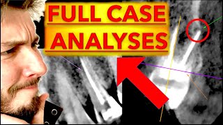 Advanced Dental Radiographs Interpretation CARIES amp Radiolucent LESIONS  OPG Xray 3D CBCT reading [upl. by Haneekas]