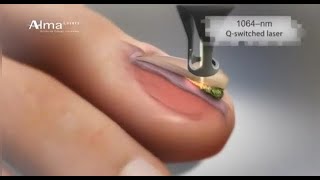 Laser Toenail Fungal Treatment [upl. by Ahseekal947]