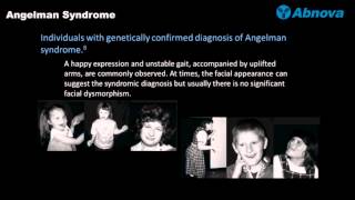 Angelman Syndrome [upl. by Kev109]