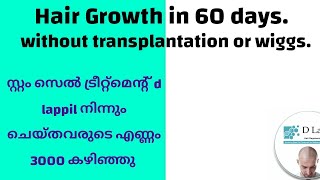 സ്റ്റംസെൽ തെറാപ്പി എടുത്തവർ 3000 തികഞ്ഞതിന്റെ സൂപ്പർ ഓഫർ stemcelltreatment hairlosstreatment [upl. by Reifnnej]