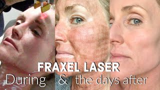 My FRACTIONAL CO2 LASER Experience  The FULL Treatment amp the DAYS following  BEFORE amp AFTER Fraxel [upl. by Schilling806]