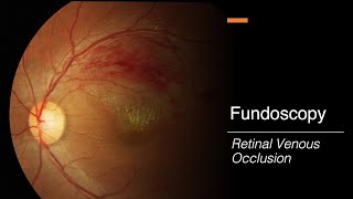 Retinal Venous Occlusion Fundoscopy [upl. by Ganny]