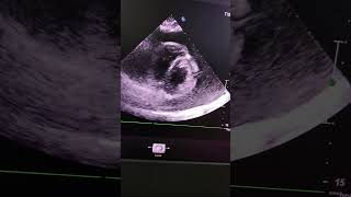 Massive Pericardial EffusionSwinging Heart Sign Clinical Pearl4 [upl. by Cthrine]