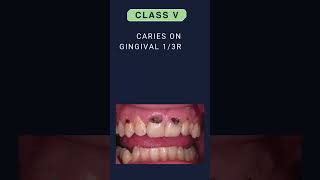 DENTAL CARIES CLASSIFICATION  GV BLACK CLASSIFICATION [upl. by Boris]