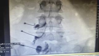 Technique to do Transforaminal Epidural steroid injection TFESI under fluoroscopic guidance [upl. by Oicaroh]