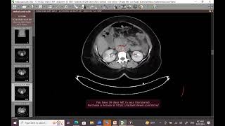 Mesenteric ischemia [upl. by Aruol179]