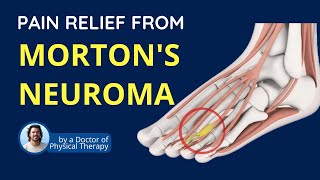 Relief from Mortons Neuroma Foot pain  Symptoms and Causes [upl. by Delogu830]