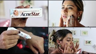 Acnestar Gel Review  HOW TO REALLY GET RID OF ACNE  SuperWowStyle Prachi [upl. by Gairc]