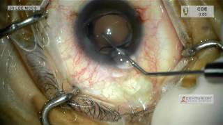 HD IOL exchange technique for hydrophilic plate type IOL [upl. by Ajoop]