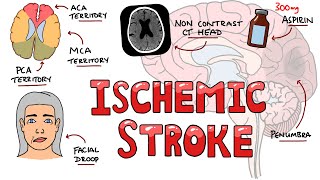 Acute Ischemic Stroke  Signs and Symptoms Stroke Syndromes  Causes amp Mechanisms  Treatment [upl. by Clemmy]