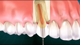 ¿Qué es la endodoncia y cómo se realiza Clínica Dental Más Bermejo Murcia [upl. by Ladnyc]