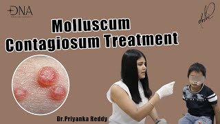 How to treat Molluscum Contagiosum  Treatment of viral skin infection  Dr Priyanka Reddy [upl. by Cimah710]