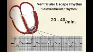 ECG part 8 Ventricular escape rhythm Accelerated idioventricular rhythm AIVR [upl. by Burner]