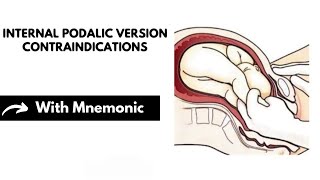 Internal Podalic Version Contraindications With Mnemonic  Obstetrics Mnemonics  Dr Mubashar Ata [upl. by Eevets]