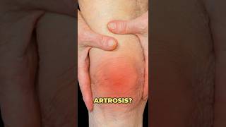 Artritis vs artrosis ¿ Cuáles son las diferencias artritis artrosis rodilla drwilsondelgado [upl. by Newo]