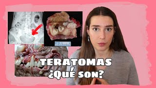 TERATOMA  un tumor peculiar [upl. by Amaryllis418]