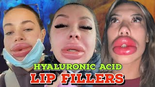 LIP INJECTIONS WITH NO NEEDLE [upl. by Tyson]