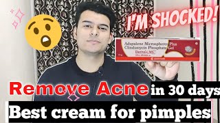 Adapalene Gel Review हिंदी में  How much effective it is for Acne amp Pimples  Deriva CMS Gel [upl. by Allekram]