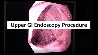 Upper GI Endoscopy Procedure in the ED [upl. by Trudy]