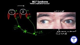 MLF syndrome  Internuclear Ophthalmoplegia MADE EASY [upl. by Lecroy]