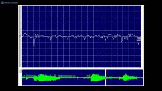 Kimura amp Kohara F12 Myotonic discharge recorded in clinically unaffected muscle [upl. by Haem448]