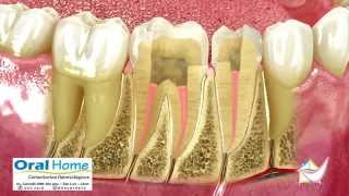 Endodoncia o tratamiento de conducto [upl. by Esorrebma]