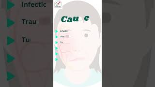 Know About Facial Nerve Palsy nerveloss facialnerveloss bellspalsy ghoshentfoundation ent [upl. by Armbruster]