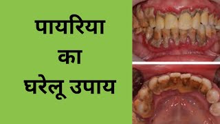 पायरिया का घरेलू उपाय home remedies for pyorrheapyorrhea treatment at homeपायरिया का ईलाज [upl. by Sanchez]