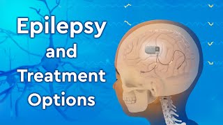 What is Epilepsy and How is it Treated [upl. by Goodspeed]