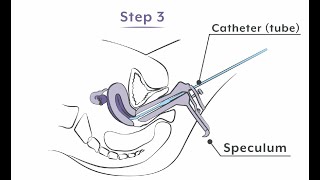 Making foam sclerotherapy using the Tessari method varicose veins [upl. by Imot]