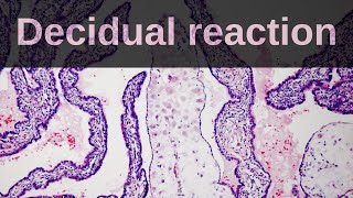 What is Decidual Reaction Pathology mini tutorial [upl. by Abita]