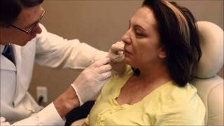 Patient Receives Juvederm Ultra Plus XC Treatment [upl. by Julian]