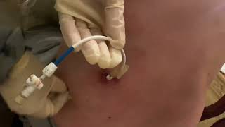 How to clean the area of nephrostomy or nephroureteral drain by Kathy [upl. by Asiluy]