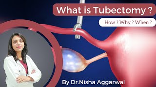 What Is Tubectomy  By DrNisha Aggarwal  How  Why  When   Female Sterilisation [upl. by Sabino]