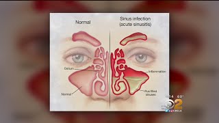 Doctor Tried And True Methods For Sinus Relief Are Still Best [upl. by Garaway]