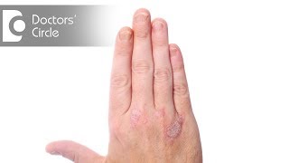 Is Psoriasis contagious  Dr Suresh G [upl. by Arahset]