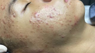 ACNE TREATMENT VU QUYNH MI  Perennial Blackheads On Boy Face 2024FULL [upl. by Alym387]