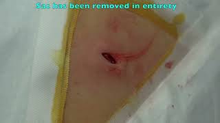 Interesting Epidermoid Cyst Removal [upl. by Chouest]