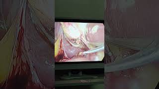 laparoscopysurgery cholecystectomy cholelithiasis gallbladder gallbladderstone gallstone [upl. by Gilda]