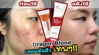 เจลแต้มสิวเทพๆ สิวหายจริงไม่โป๊ะแตก Dragon Blood Anti Acne  Scar Gel มันดีอ่ะ  Happy Yammy Story [upl. by Hayotal124]