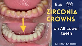 How teeth capping is done  zirconia crowns  Dental crowns  कैपिंग कैसे की जाती है [upl. by Idelle]