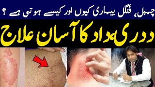 Fungal Infection treatment in urdu  Dad or Dadri k Ilaaj ka Tarika by Dr Raheel Shehzad Rathore [upl. by Nolitta]