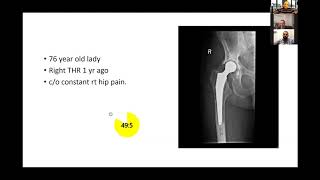 Periprosthetic joint infection  viva practice for the FRCS Trauma and Orthopaedics exam [upl. by Ennayelhsa]