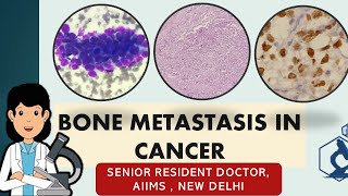 Bone metastasis in cancer Symptoms and diagnosis  A casebased study [upl. by Yrtneg828]