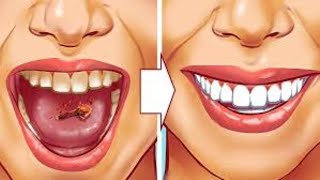 9 Natural Ways to Remove Plaque amp Tartar Buildup  Say Goodbye to Dental Problems [upl. by Charlena73]